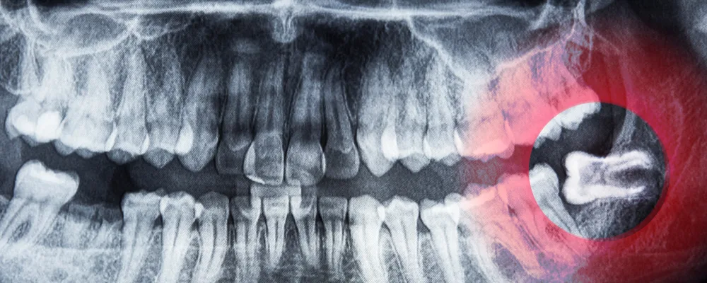 親知らずは抜くべき？残す・抜くを分ける4つの判断軸｜マルイ錦糸町シティデンタルクリニック
